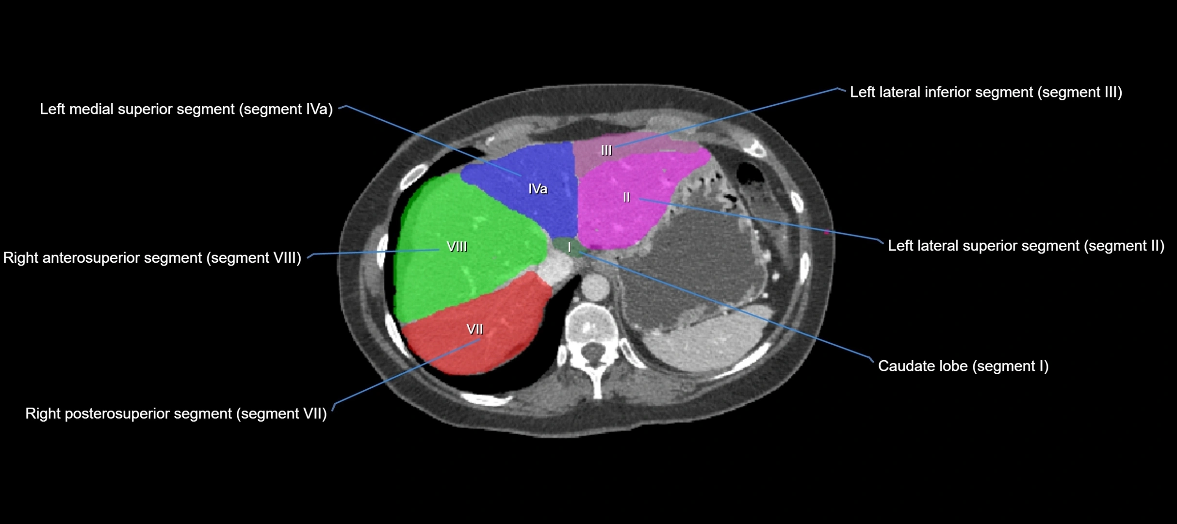 CT liver segments axial cross sectional anatomy labelled image-00061.webp